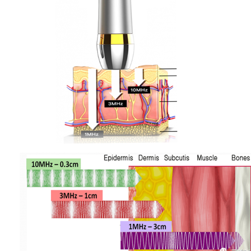 The10MHz Ultrasonic Beauty Instrument developed by the company